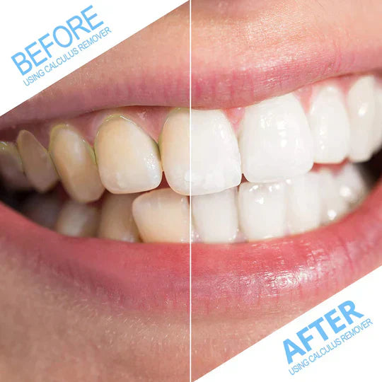 Dental Calculus Remover - PureSmile Essentials