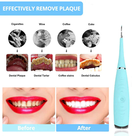 Dental Calculus Remover - PureSmile Essentials