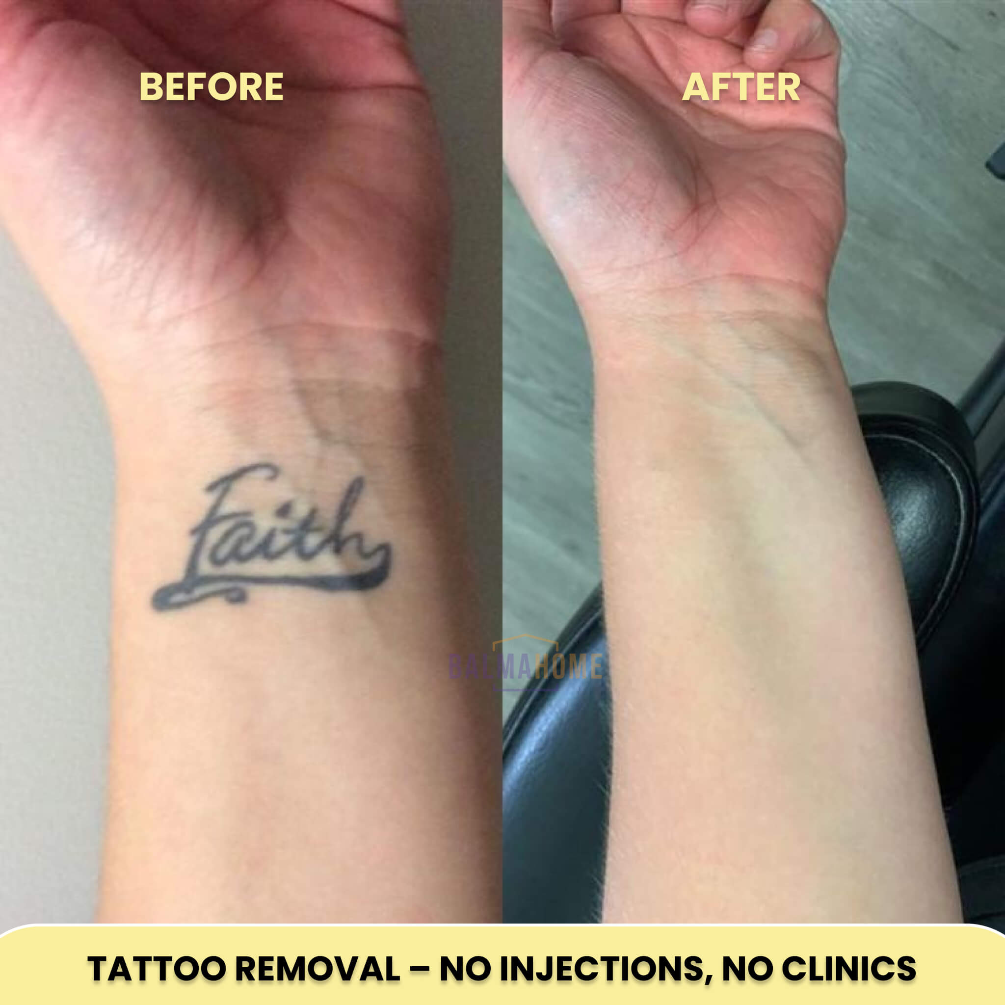 Tattoo Removal Laser Pen - InkFade Pro