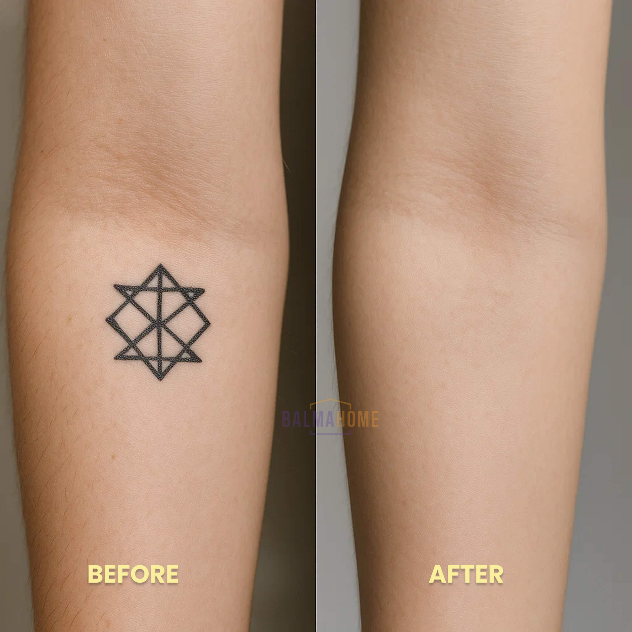 Tattoo Removal Laser Pen - InkFade Pro