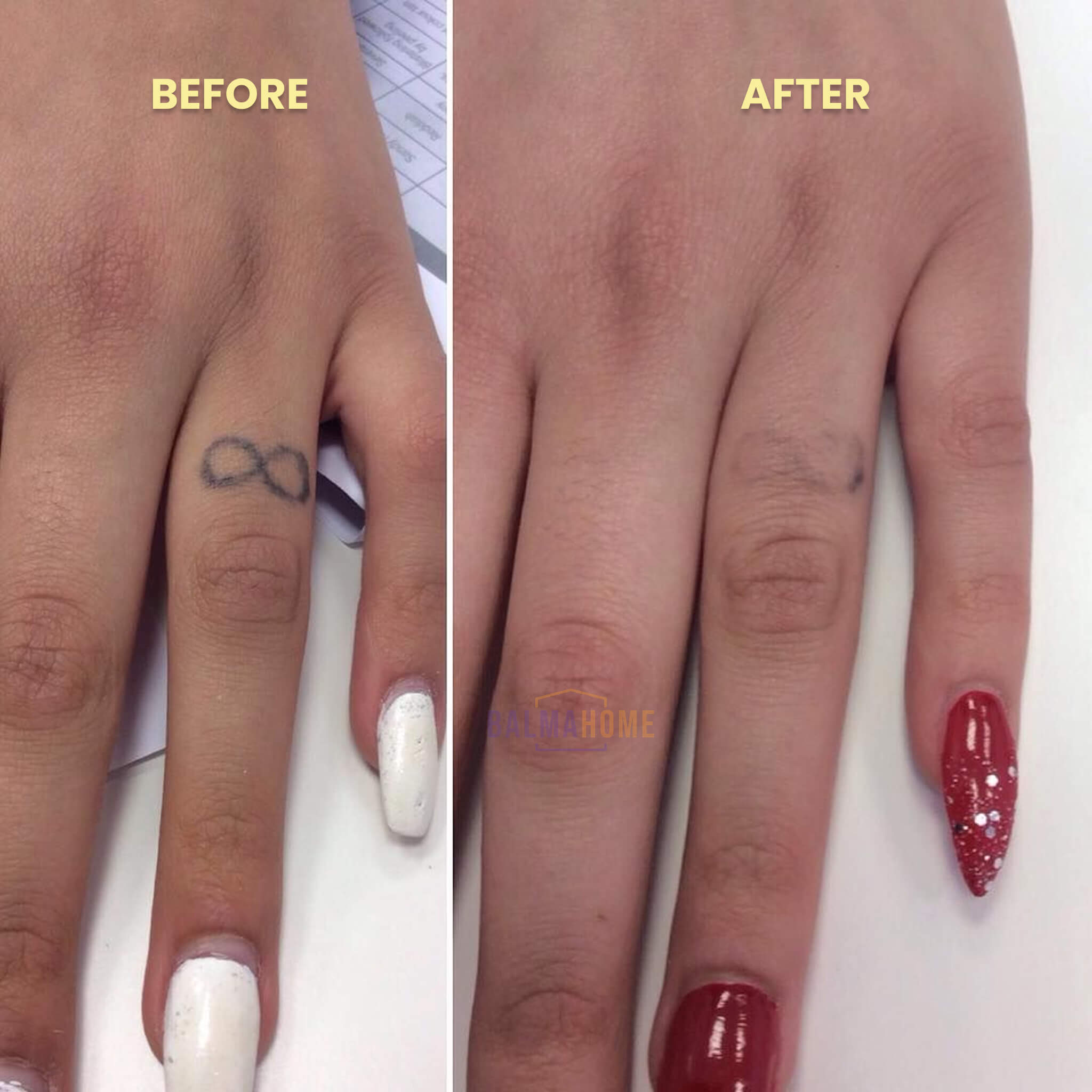 Tattoo Removal Laser Pen - InkFade Pro