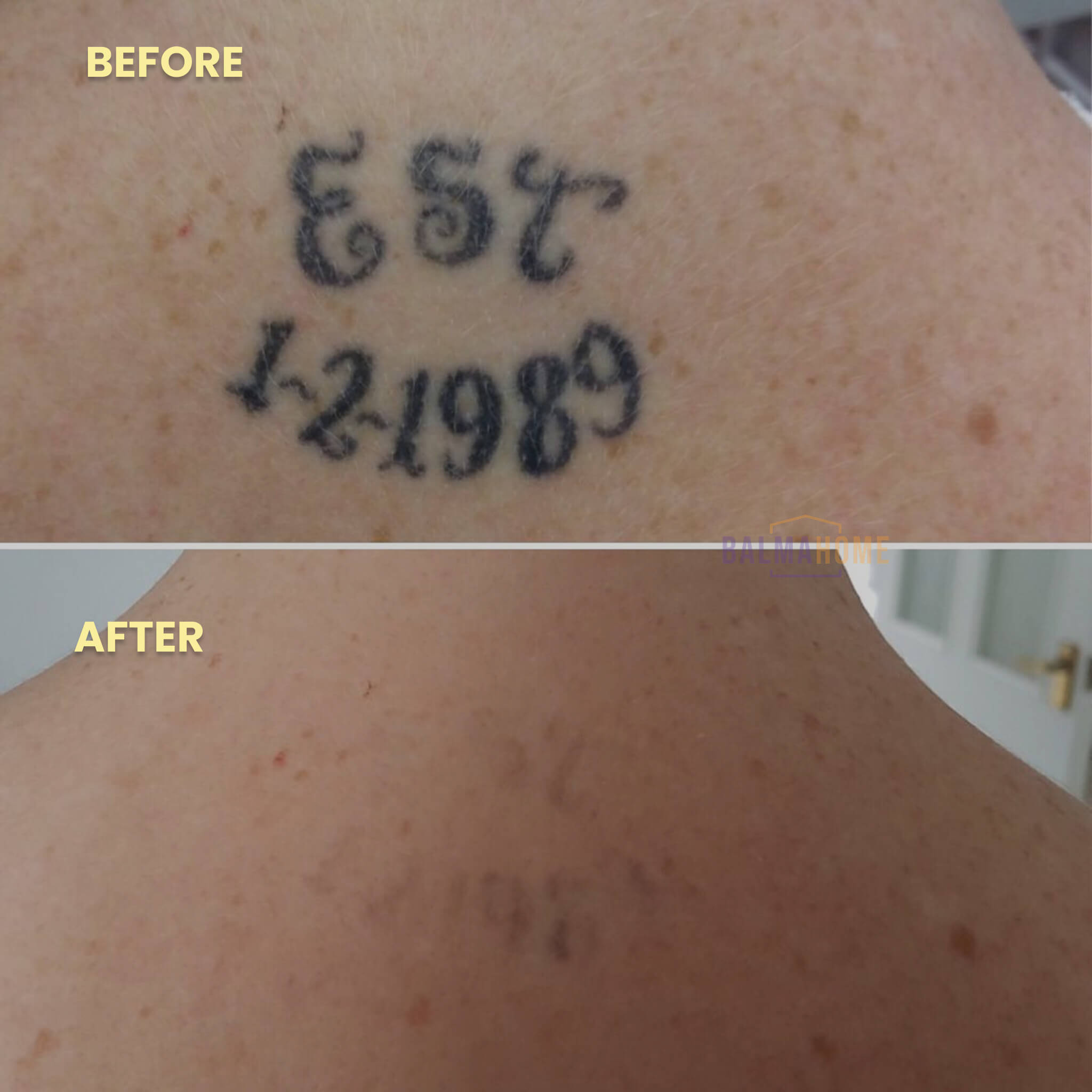 Tattoo Removal Laser Pen - InkFade Pro