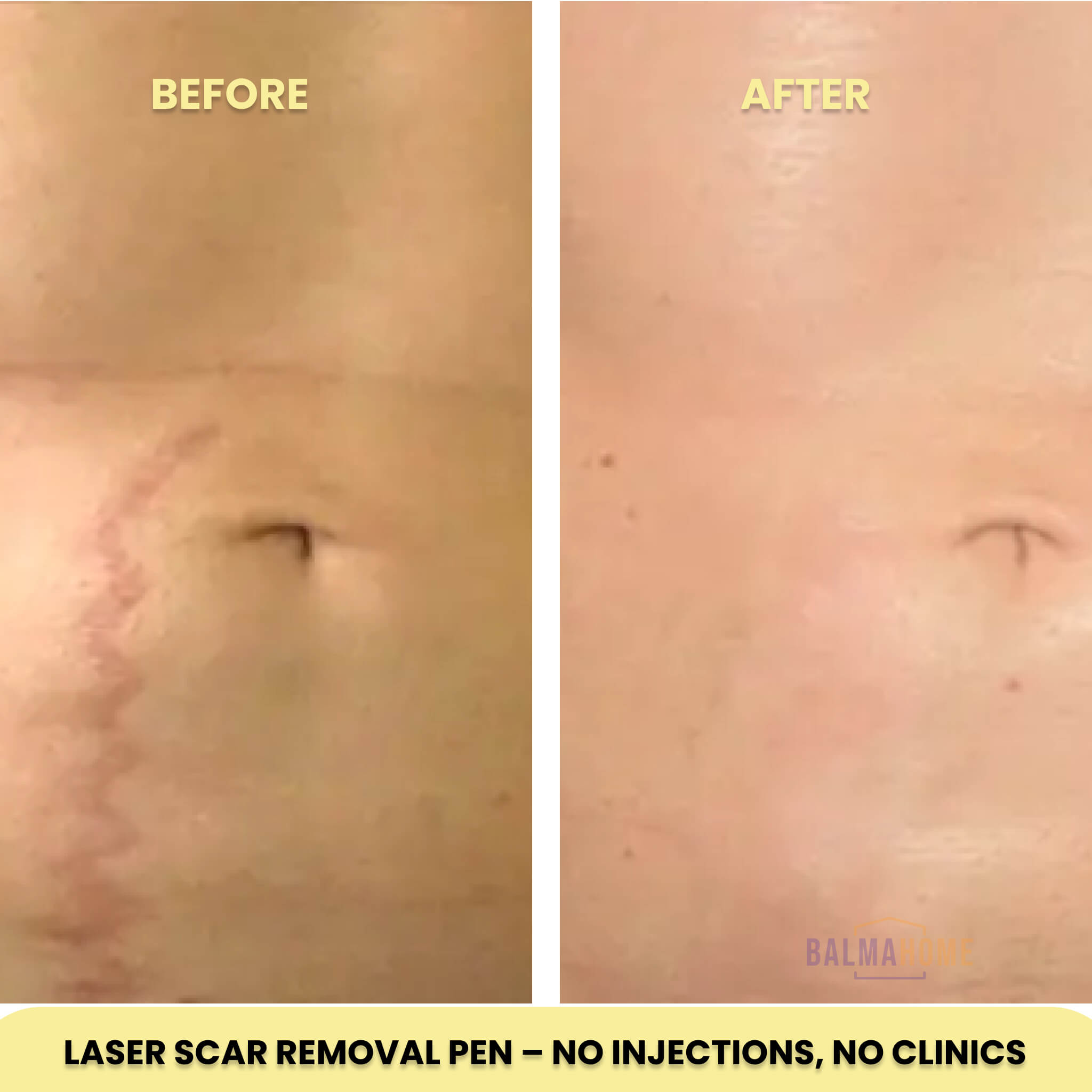 ScarAway Laser Pen - ReviveSkin