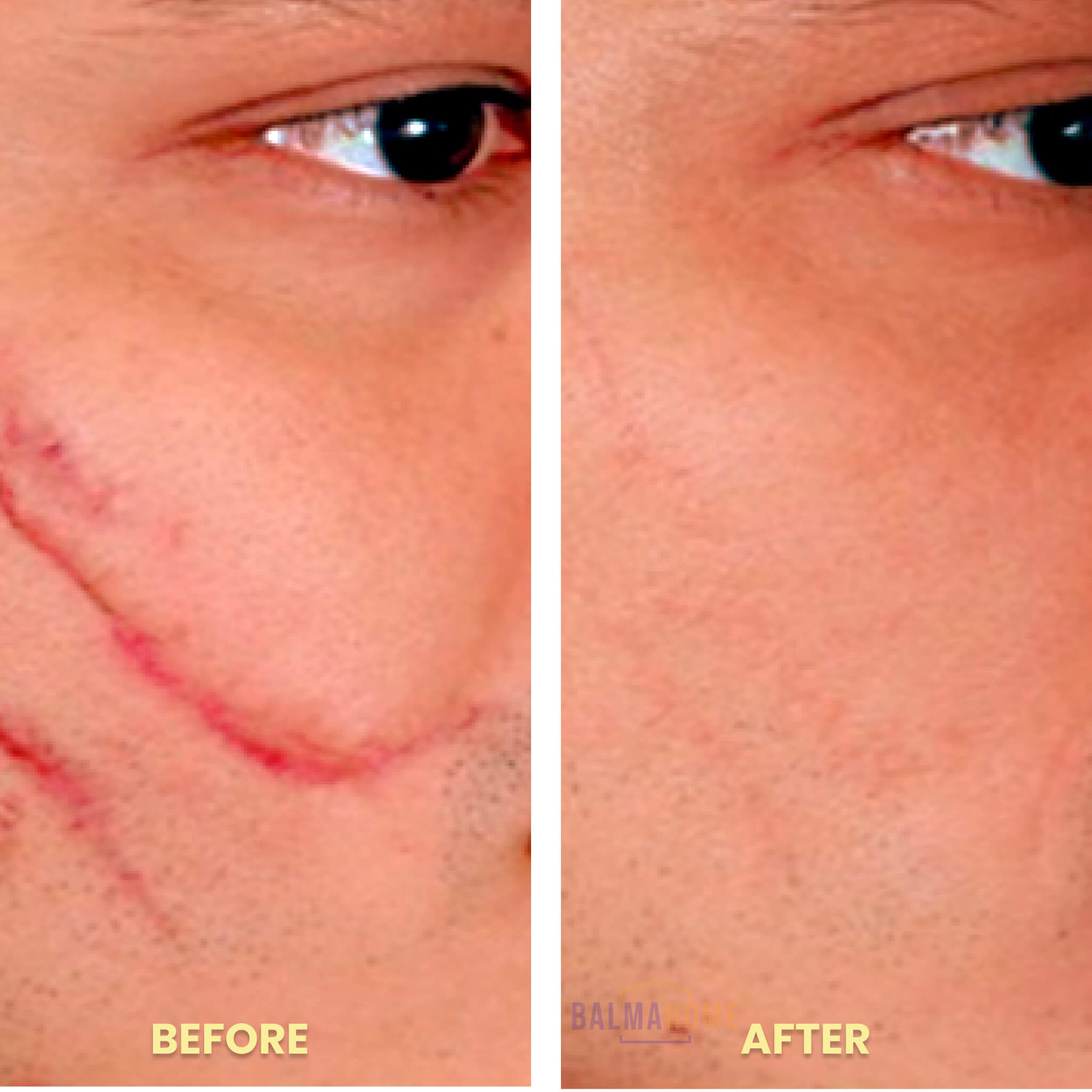 ScarAway Laser Pen - ReviveSkin