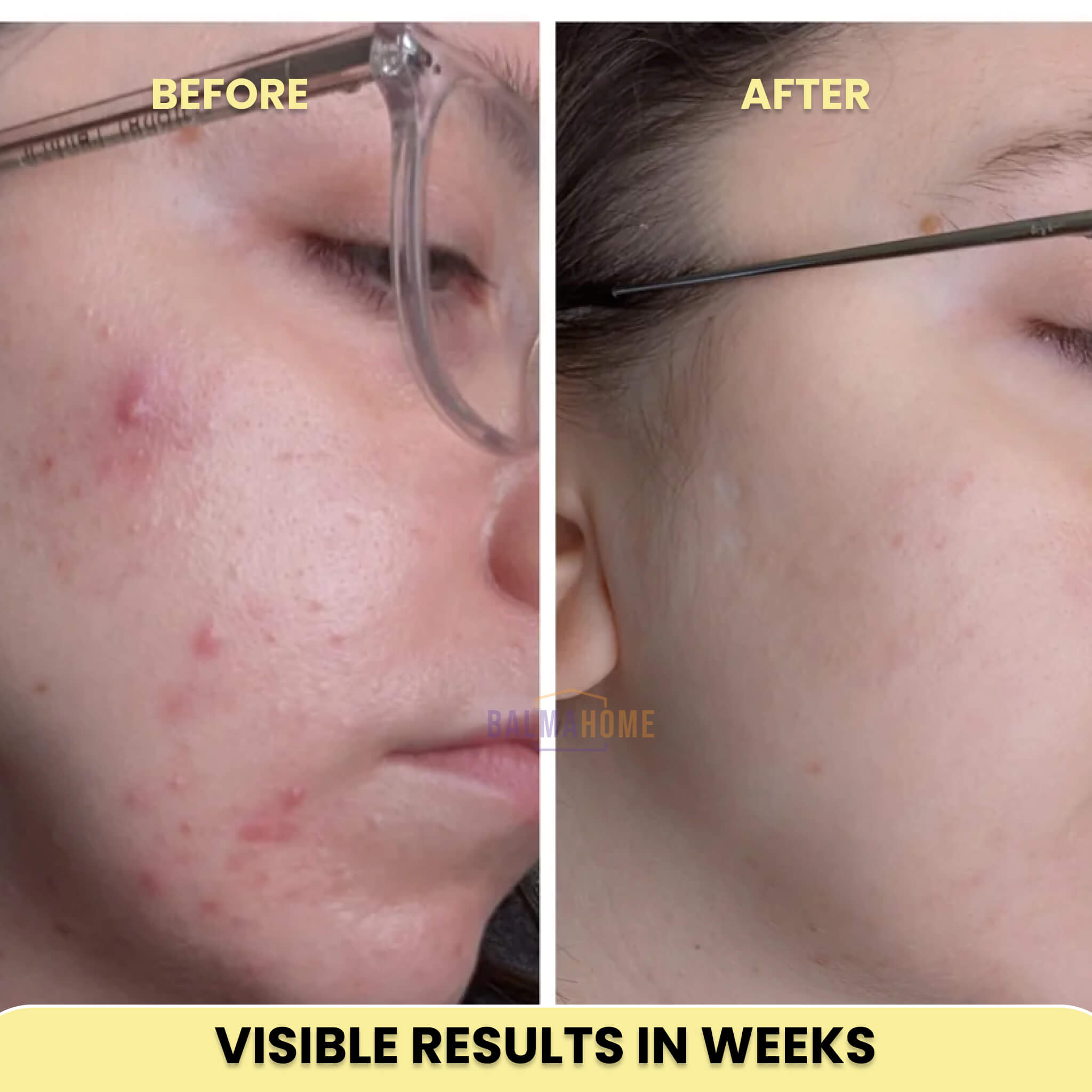 ScarAway Laser Pen - ReviveSkin