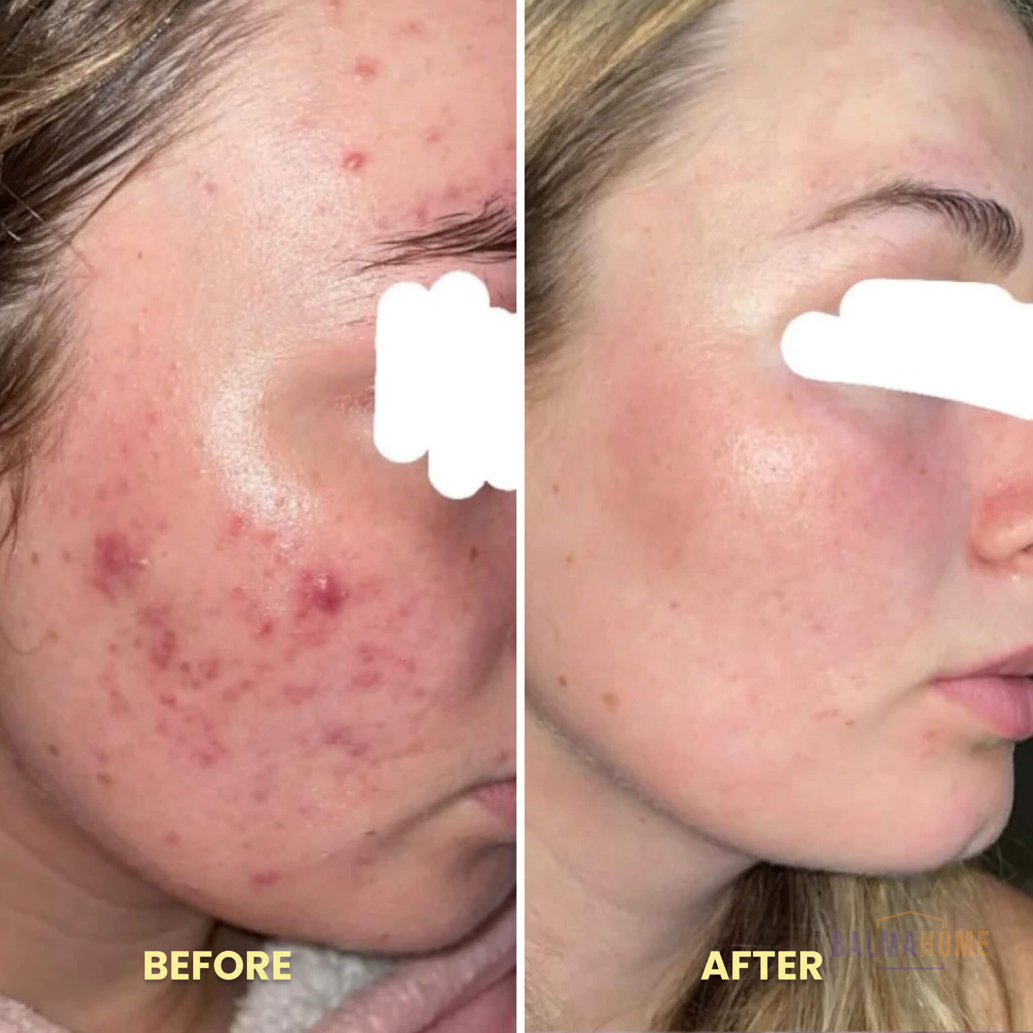 ScarAway Laser Pen - ReviveSkin