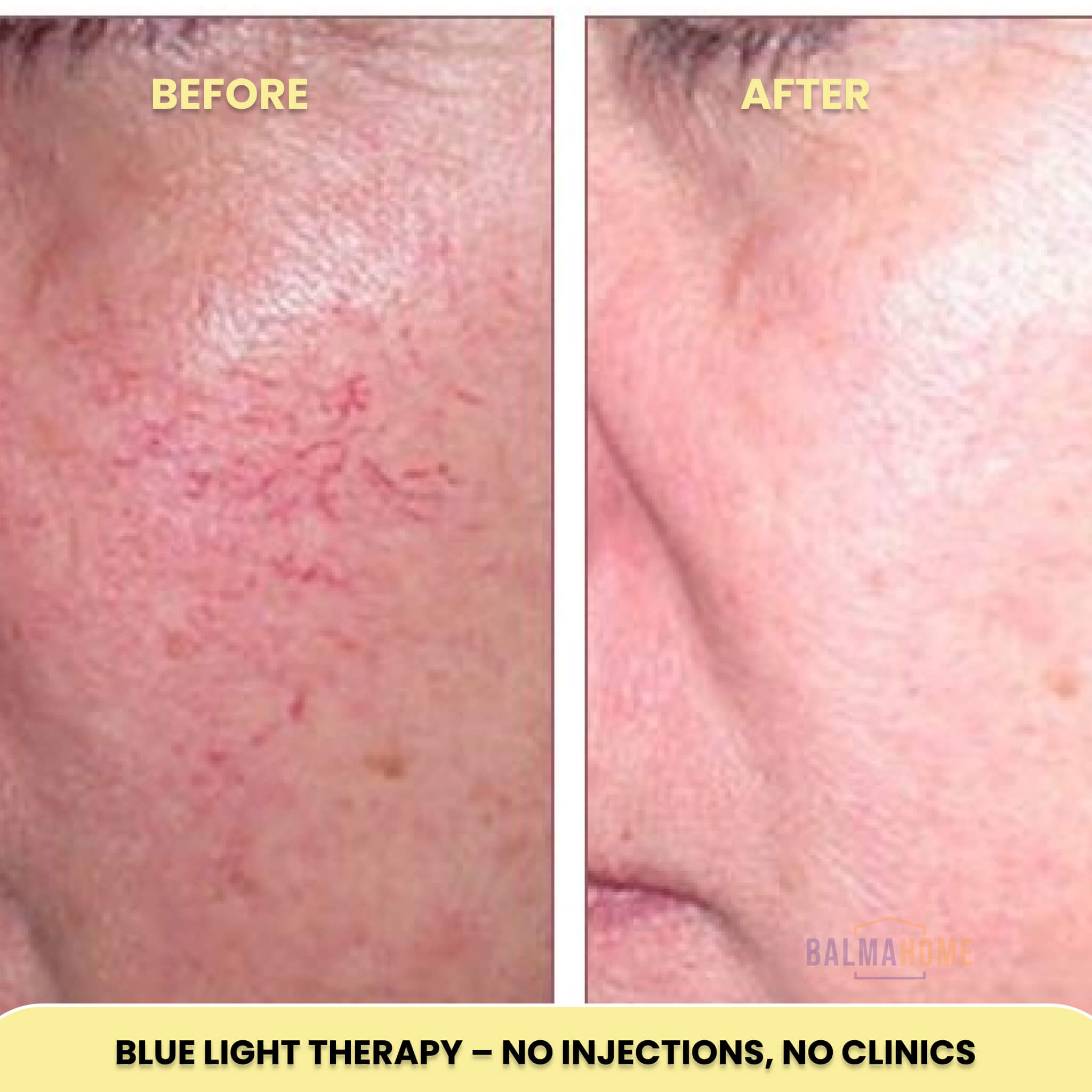 Blue Light Therapy Device - ClearSkin Essentials