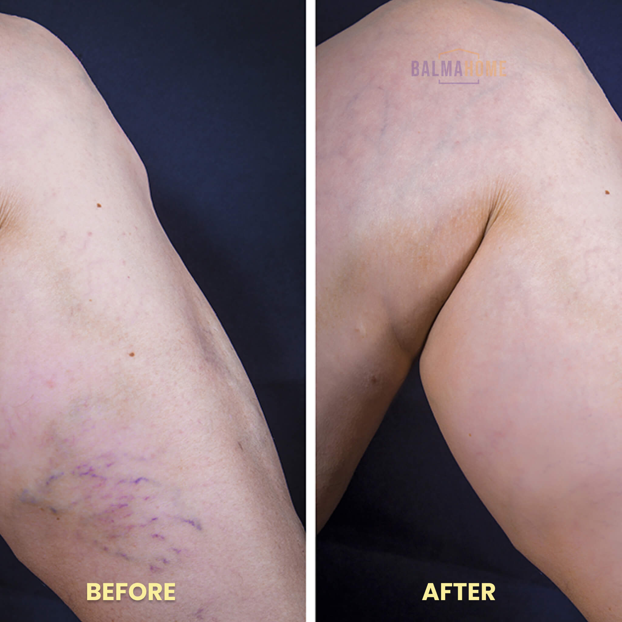 Blue Light Therapy Device - ClearSkin Essentials