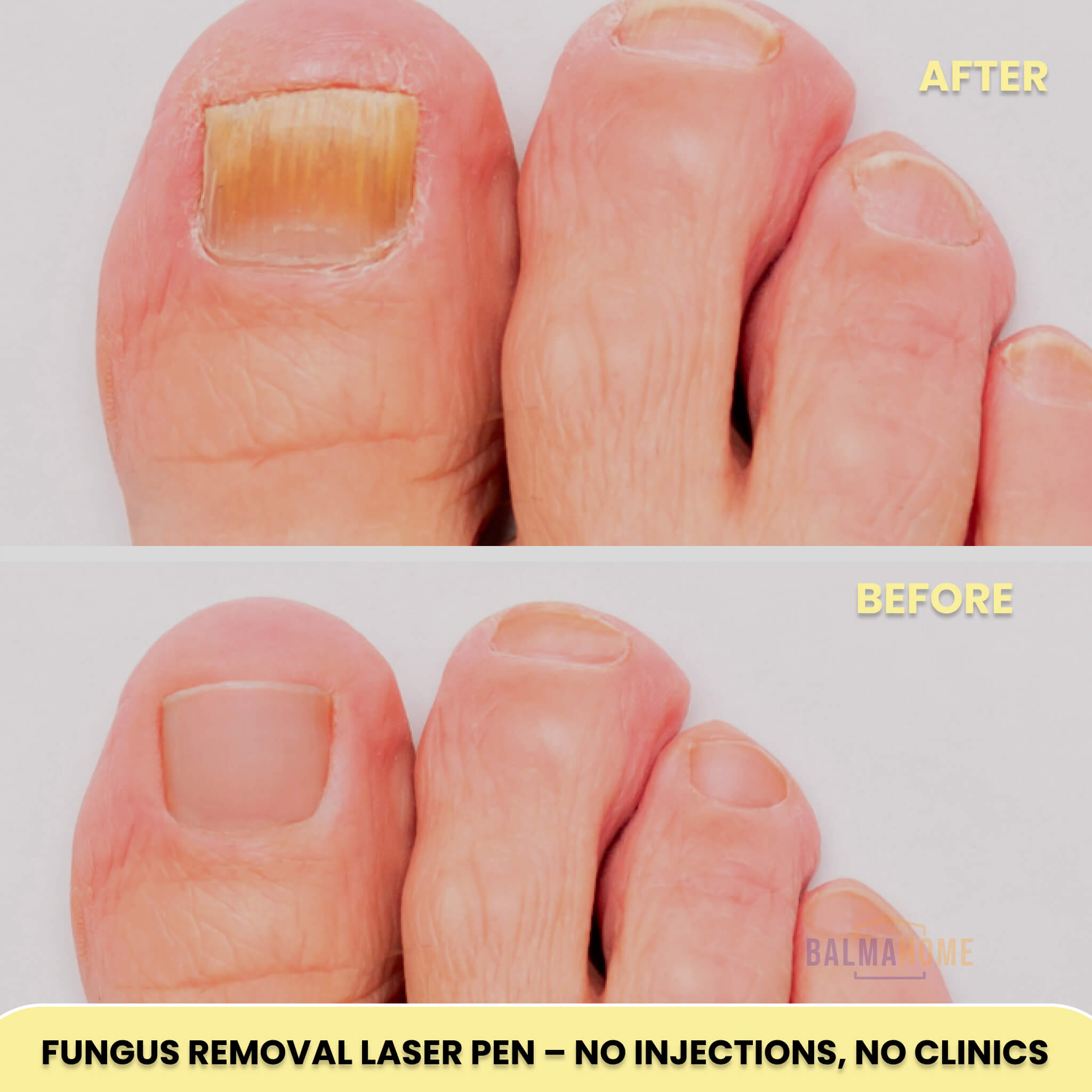 Fungus Removal Laser Pen - PureGlow