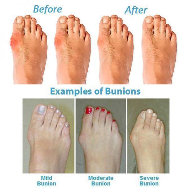 Orthopedic Toe Corrector Sandals - SoleHarmony